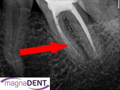 usuwanie złamanych narzędzi z kanału zęba leczenie kanałowe pod mikroskopem po zabiegu